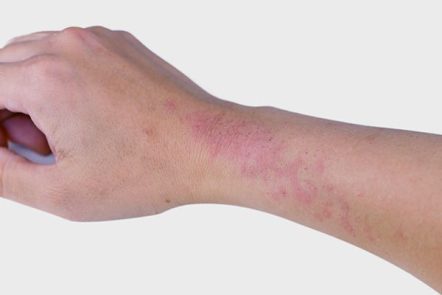 بیماری اگزما پوستی چیست؟ علائم و راه های درمان آن