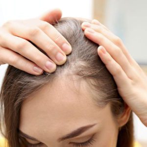 Oral minoxidil ماینوکسیدیل ریزش مو در زنان