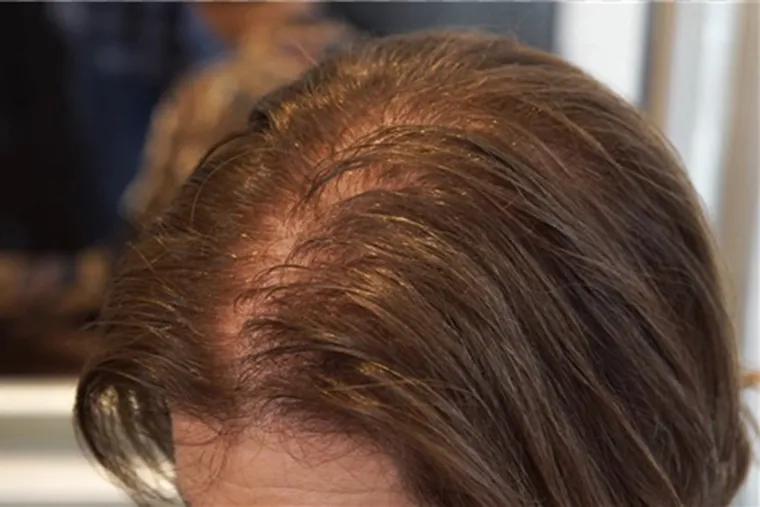 از چه محصولاتی برای درمان با موهای نازک در اسرع وقت استفاده کنید، و اینکه بدانید درمان موهاي نازك و ضعیف چیست اين مقاله را بخوانید.