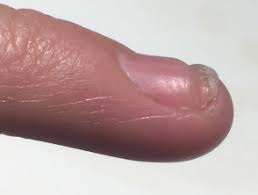 چرا پوست زیر ناخن از ناخن هایم بلندتر ميشود؟ Hyponychium اصطلاحی برای پوست ضخیم زیر لبه آنست است. این می تواند ناشی از ژنتیک
