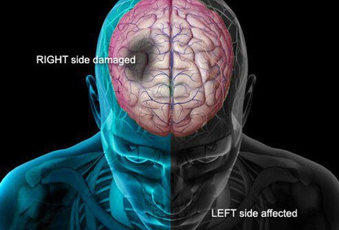 علائم و نشانه های سکته مغزی در مردان و زنان عبارتند از:١- ضعف یا بی حسی ناگهانی در یک طرف صورت یا در یک دست یا پا٢- از دست دادن بینایی