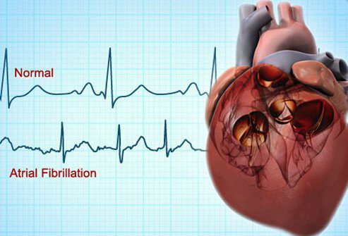 اگر قلب شما به جای تپش، بشدت ضربه ميزند و برای چند دقیقه طول می کشد، نشانه ای است که ممکن است به بیماری به نام فیبریلاسیون دهلیزی