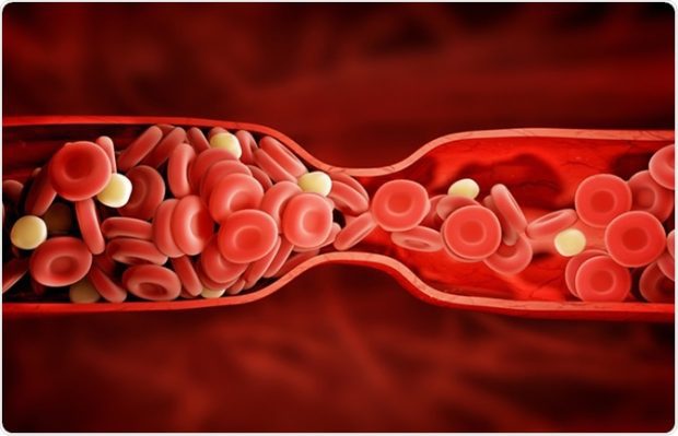 Thrombolysis که به عنوان ترومبولیتیک درمانی نیز شناخته می شود، درمانی برای رفه لخته های خطرناک در رگ های خونی، بهبود جریان خون