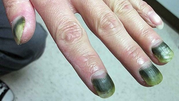 سندرم ناخن سبز یا GNS Green nail syndromeیک عفونت ناخن است که منجر به تغییر رنگ مایل به سبز در ناخن ها ...سبز شدن ناخن زیرکاشت